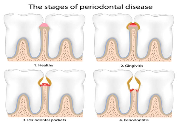 Gum disease