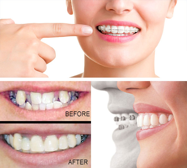 Orthodontic Treatment