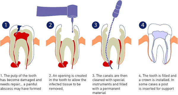 Root Canal Treatment (RCT)