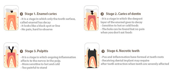 Treating Dental Caries