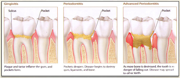 Treating The Gums