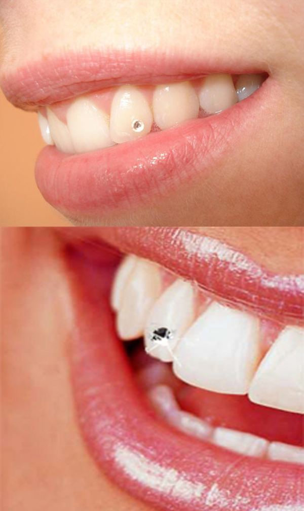 dental Jewelry