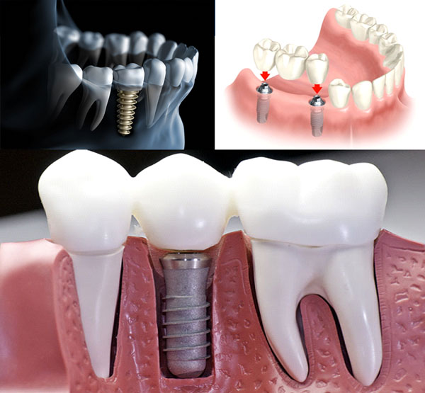 dental implants